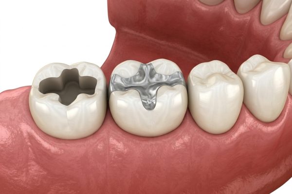 Dental Fillings