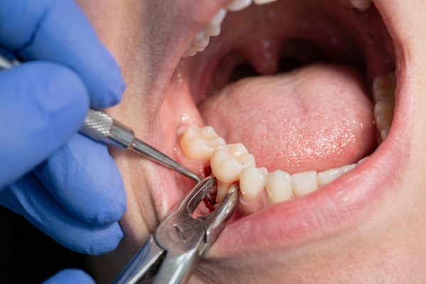 Wisdom Tooth Removal